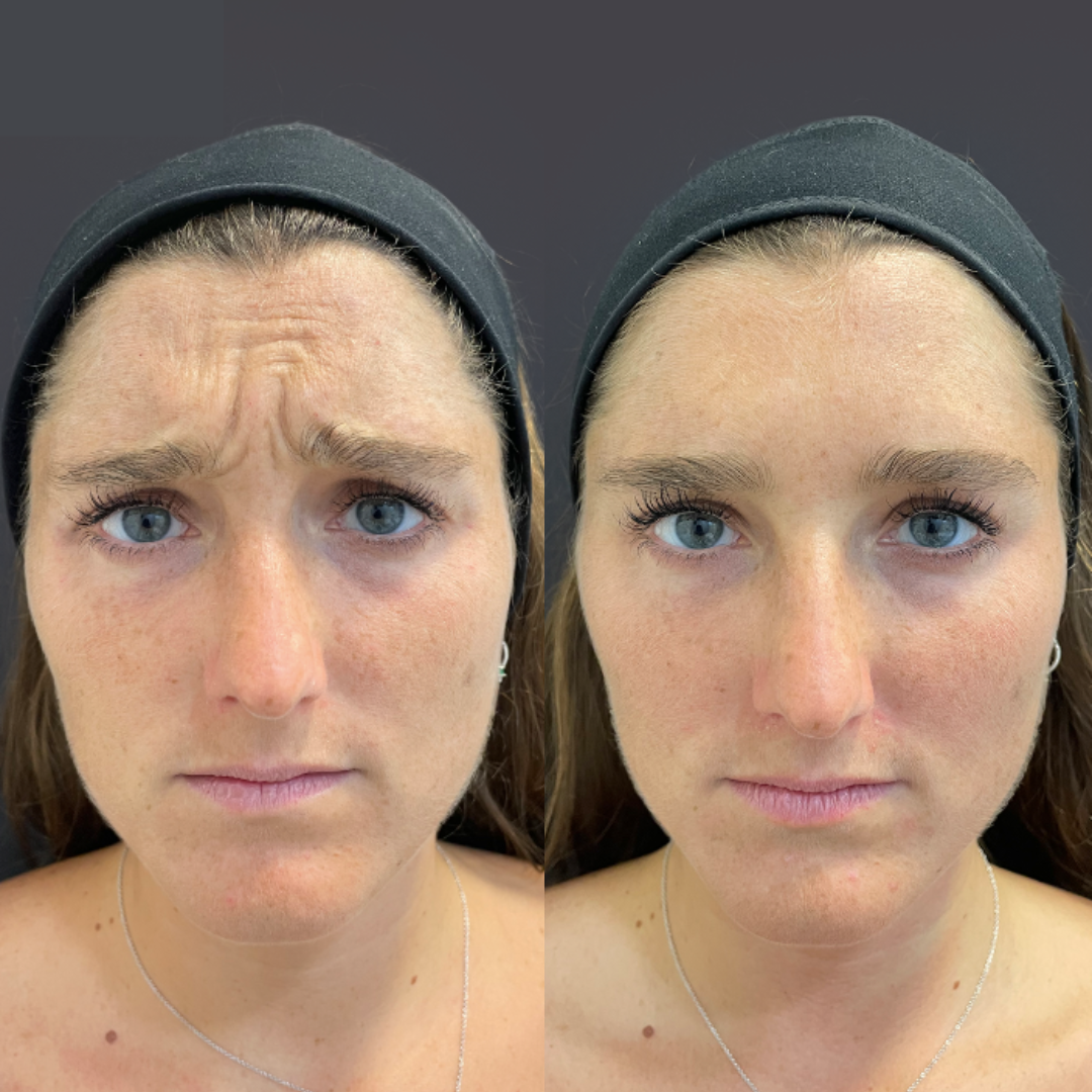Serum Noni Fiorenza®️